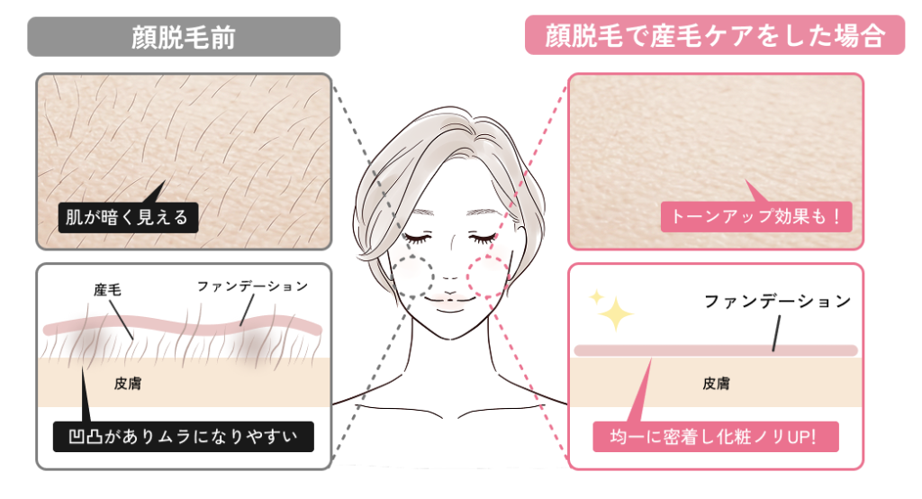 顔脱毛による産毛ケアの説明図