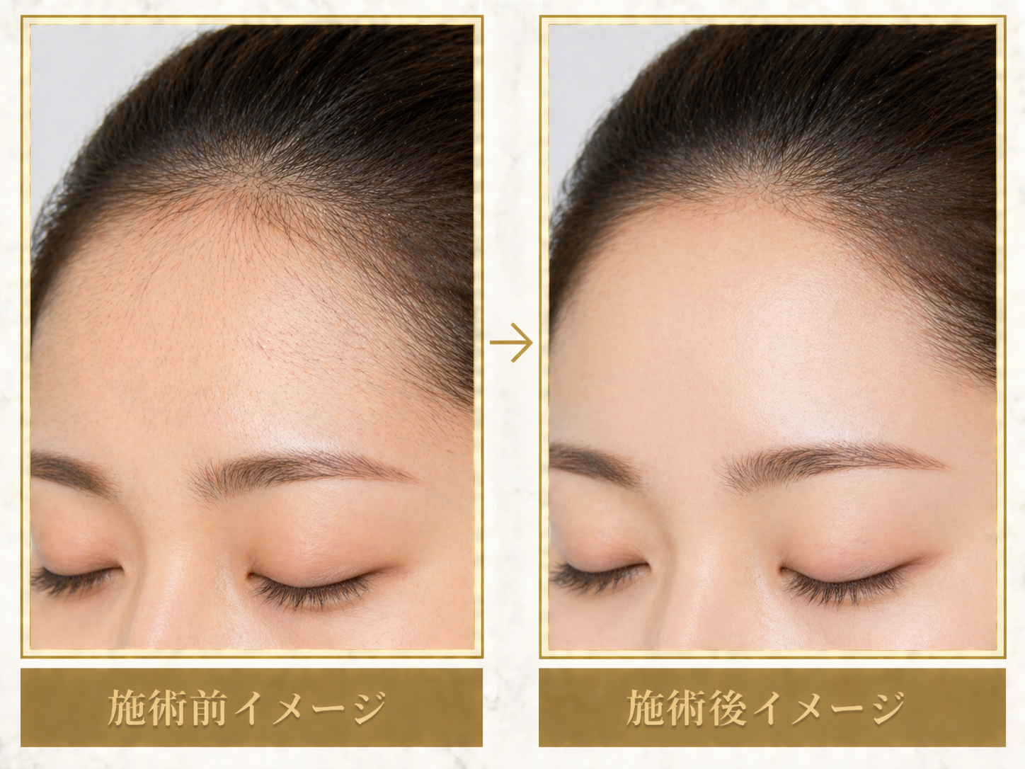 おでこ脱毛イメージ1