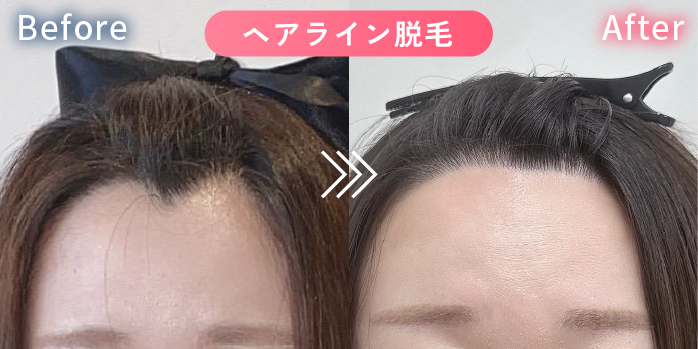 ヘアライン脱毛の症例写真1