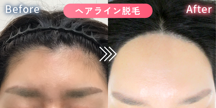 ヘアライン脱毛の症例写真2