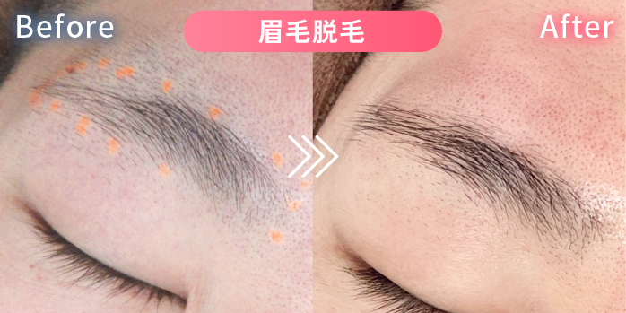眉毛脱毛の症例写真1
