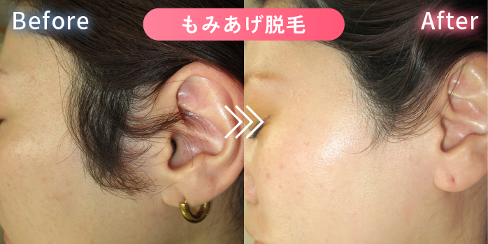 もみあげ脱毛の症例写真2