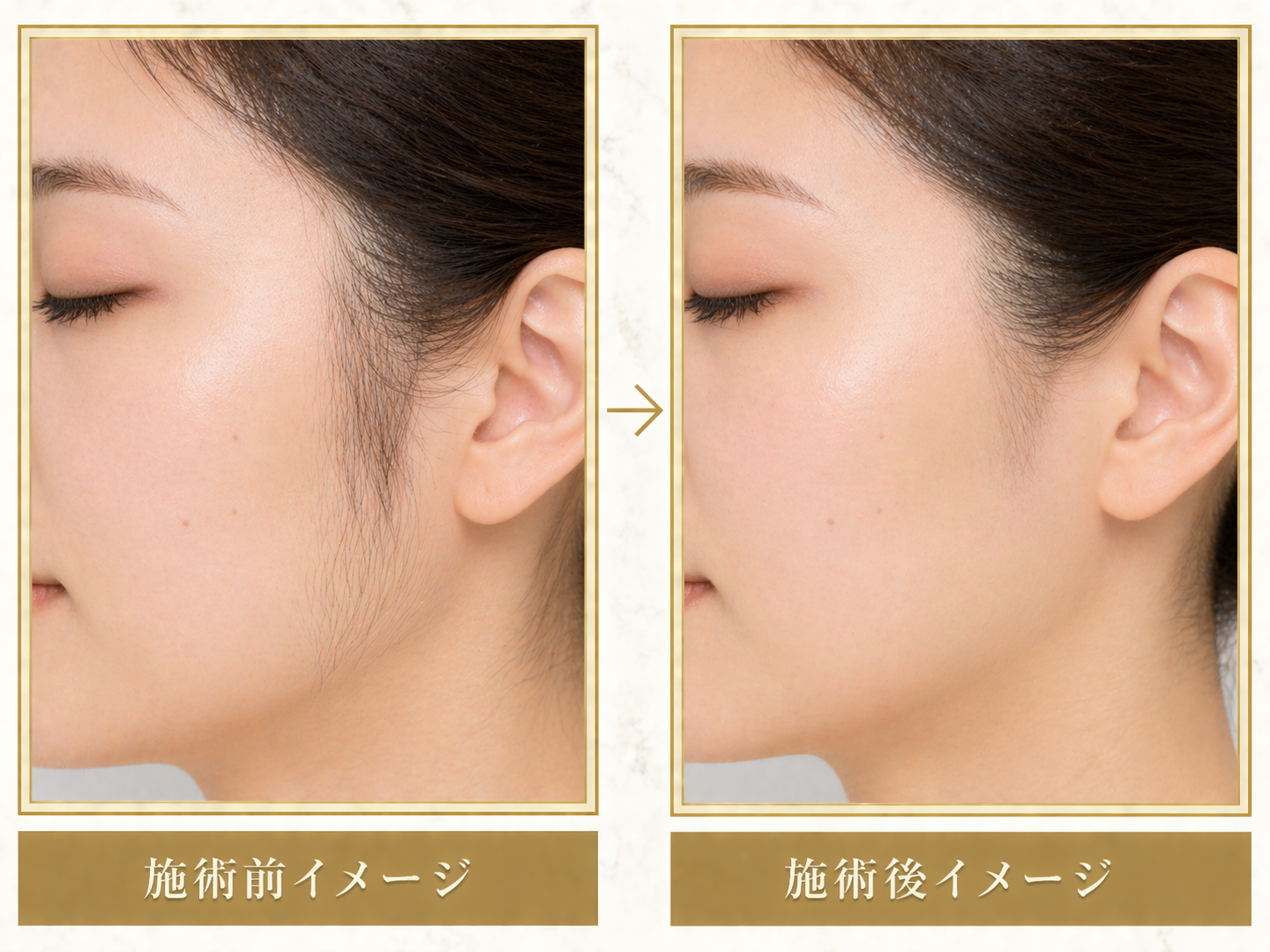 もみあげ脱毛イメージ1