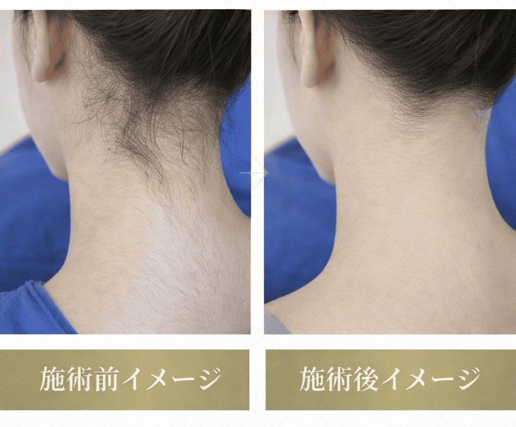 うなじ脱毛のビフォーアフター