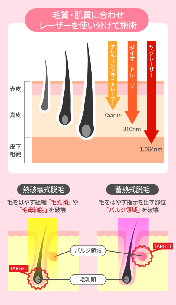 熱破壊式脱毛と蓄熱式脱毛